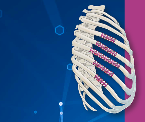 MedXpert Stracos clip 3D de titanio para estabilización costal