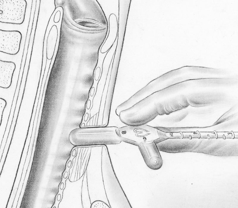 Medidor de estoma Boston Medical STOMEASURE para medir diámetro
