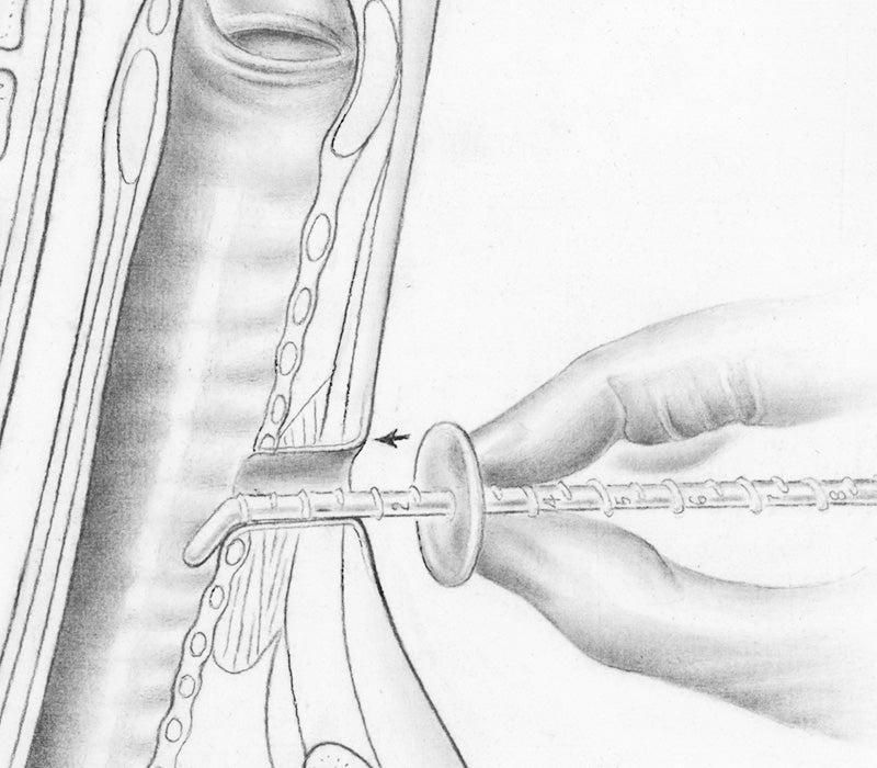 Medidor de estoma Boston Medical STOMEASURE para medir longitud