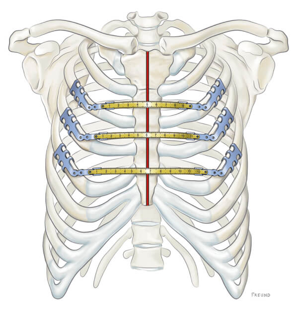 Ilustración de cierre esternal con clips de titanio MedXpert STRATOS