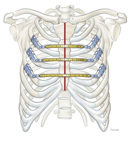 Ilustración de cierre esternal con clips de titanio MedXpert STRATOS