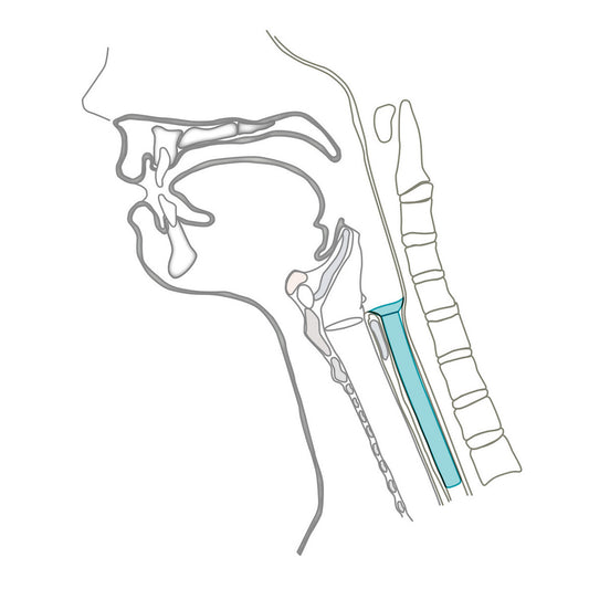 Ilustración del tubo de derivación salival Montgomery en el esófago cervical
