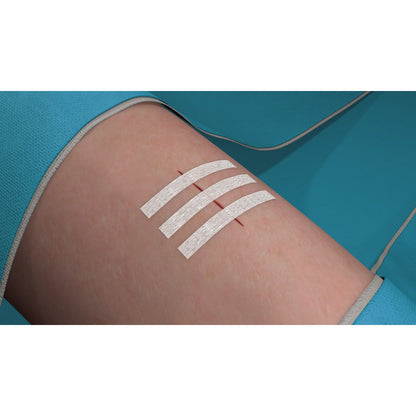 Tres tiras Steri-Strip paralelas cerrando una herida, a 3 mm entre sí