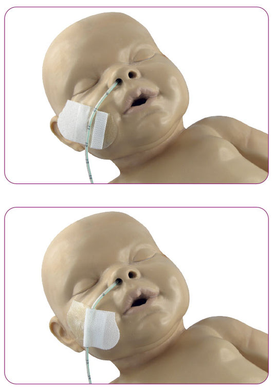 Vygon Grip-Lok 5804.11 abierto y cerrado sobre un neonato de simulación, fijando una sonda nasogástrica